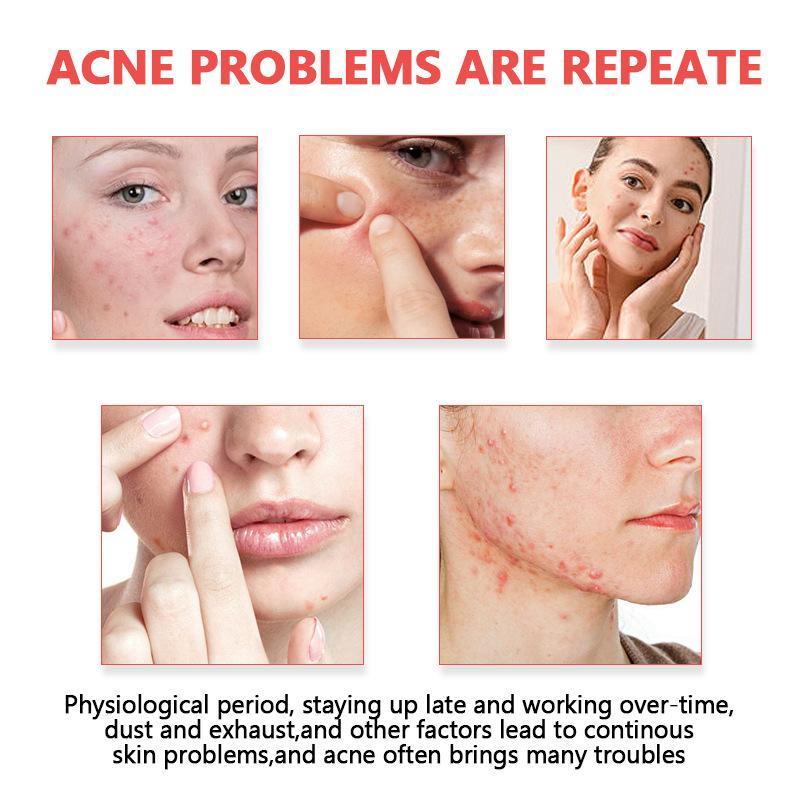 Acne Patches Invisible Hydroco - Skincare Oil Control review and price